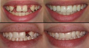 before and after teeth surgey